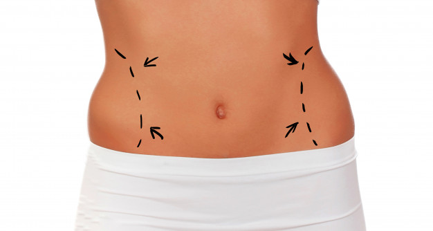 abdominoplastika